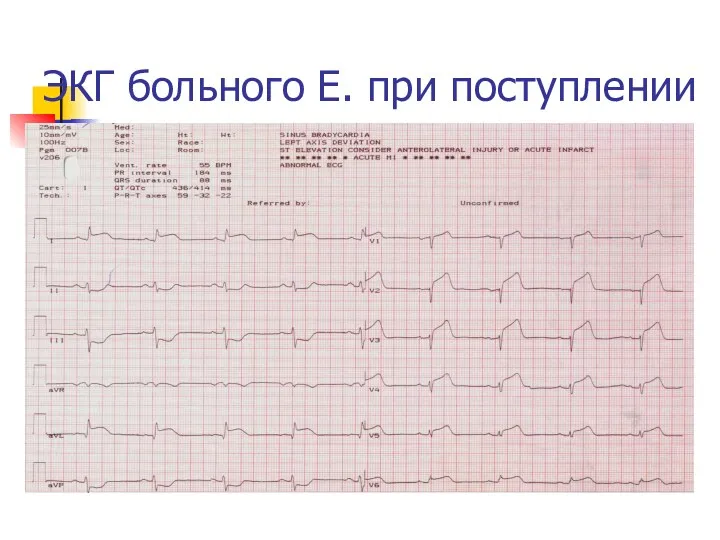 ЭКГ больного Е. при поступлении