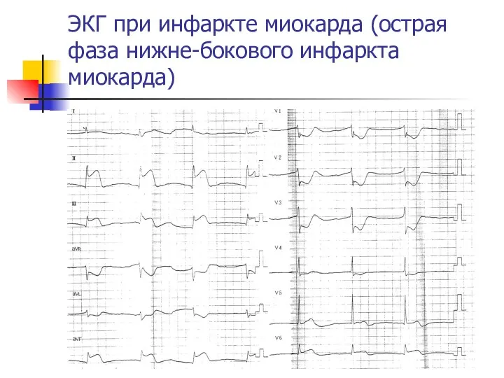 ЭКГ при инфаркте миокарда (острая фаза нижне-бокового инфаркта миокарда)