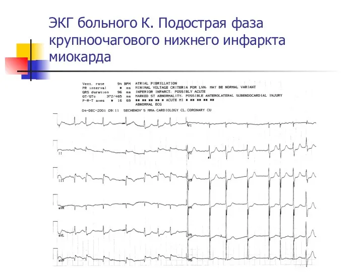 ЭКГ больного К. Подострая фаза крупноочагового нижнего инфаркта миокарда