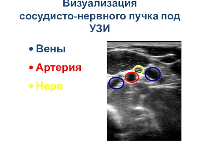 Визуализация сосудисто-нервного пучка под УЗИ Вены Артерия Нерв