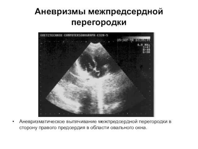 Аневризмы межпредсердной перегородки Аневризматическое выпячивание межпредсердной перегородки в сторону правого предсердия в области овального окна.