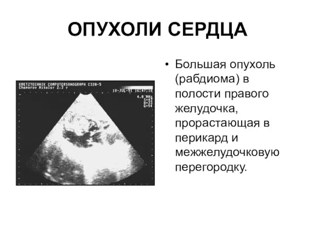 ОПУХОЛИ СЕРДЦА Большая опухоль (рабдиома) в полости правого желудочка, прорастающая в перикард и межжелудочковую перегородку.