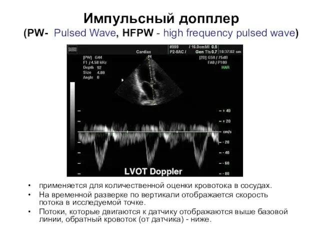 Импульсный допплер (PW- Pulsed Wave, HFPW - high frequency pulsed