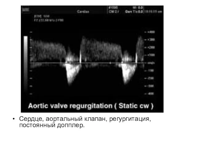 Сердце, аортальный клапан, регургитация, постоянный допплер.
