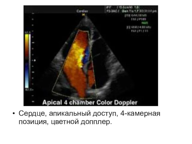 Сердце, апикальный доступ, 4-камерная позиция, цветной допплер.