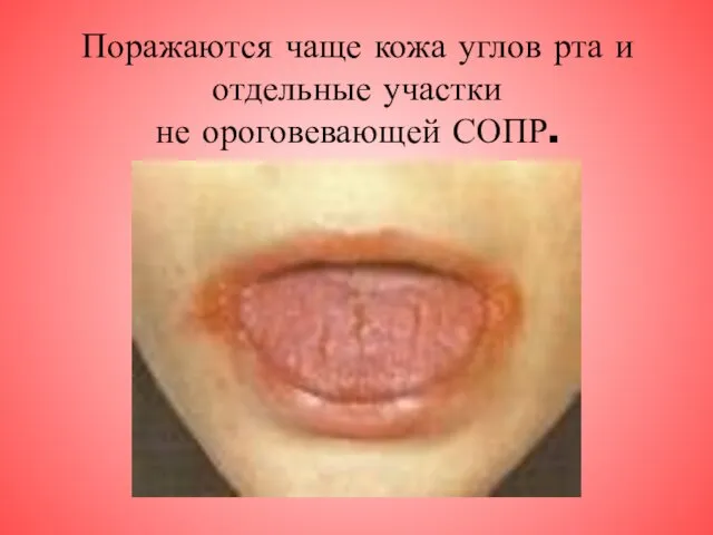 Поражаются чаще кожа углов рта и отдельные участки не ороговевающей СОПР.