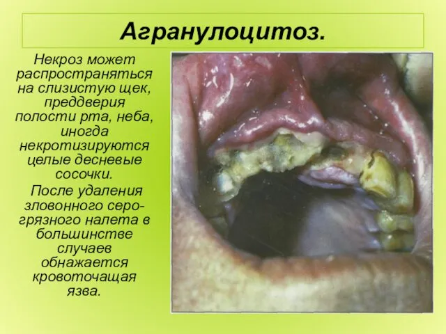 Агранулоцитоз. Некроз может распространяться на слизистую щек, преддверия полости рта,
