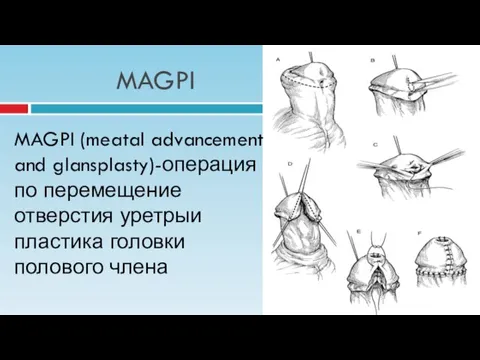 MAGPI MAGPI (meatal advancement and glansplasty)-операция по перемещение отверстия уретрыи пластика головки полового члена