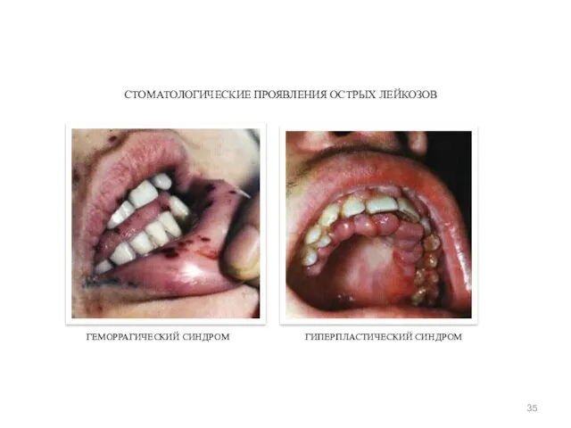 ГЕМОРРАГИЧЕСКИЙ СИНДРОМ ГИПЕРПЛАСТИЧЕСКИЙ СИНДРОМ СТОМАТОЛОГИЧЕСКИЕ ПРОЯВЛЕНИЯ ОСТРЫХ ЛЕЙКОЗОВ