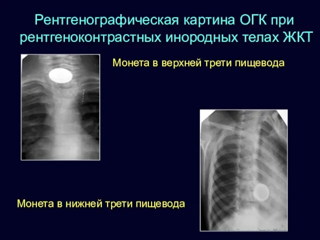 Рентгенографическая картина ОГК при рентгеноконтрастных инородных телах ЖКТ Монета в верхней трети пищевода