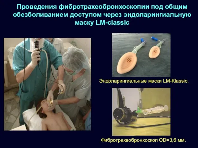 Проведения фибротрахеобронхоскопии под общим обезболиванием доступом через эндоларингиальную маску LM-classic Эндоларингиальные маски LM-Klassic. Фибротрахеобронхоскоп OD=3,6 мм.