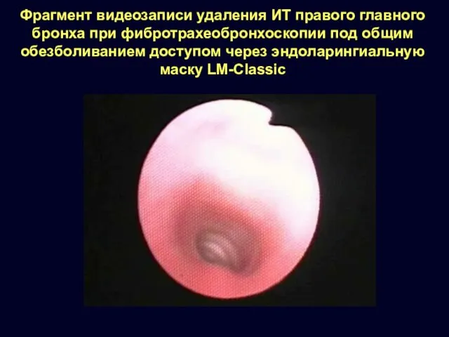 Фрагмент видеозаписи удаления ИТ правого главного бронха при фибротрахеобронхоскопии под общим обезболиванием доступом
