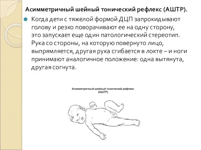 Асимметричный шейный тонический рефлекс (АШТР). Когда дети с тяжелой формой