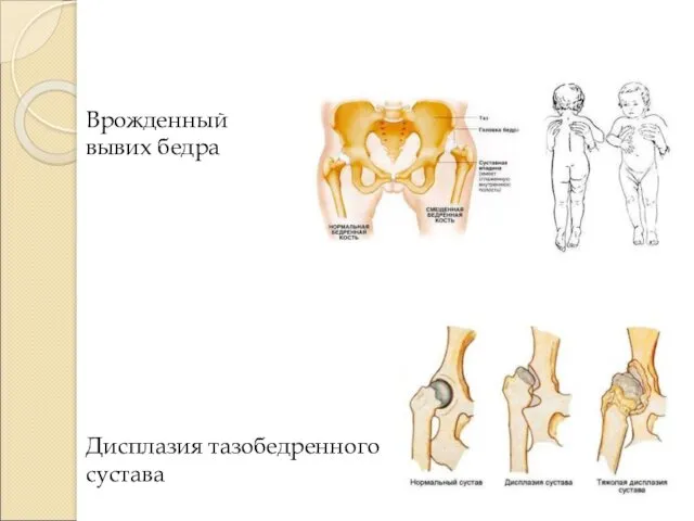 Врожденный вывих бедра Дисплазия тазобедренного сустава