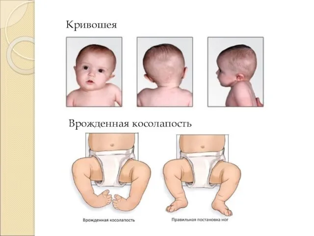 Кривошея Врожденная косолапость