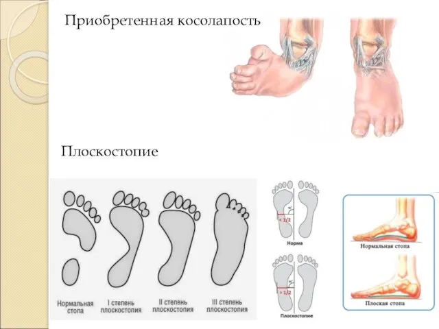 Приобретенная косолапость Плоскостопие