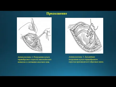 Аппендэктомия. 4. Погружение культи червеобразного отростка анатомическим пинцетом и стягивание