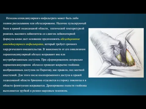 Исходом аппендикулярного инфильтрата может быть либо полное рассасывание или абсцедирование.