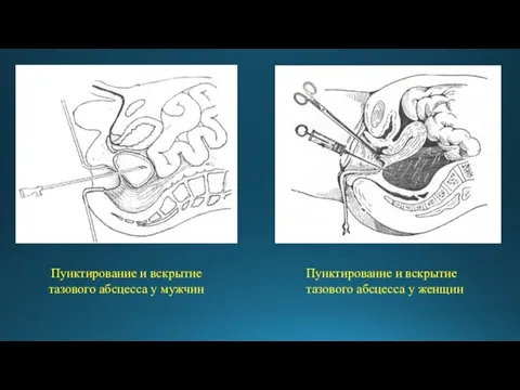 Пунктирование и вскрытие тазового абсцесса у мужчин Пунктирование и вскрытие тазового абсцесса у женщин