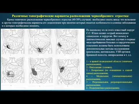 Кроме типичного расположения червеобразного отростка (40-50% случаев) необходимо иметь ввиду