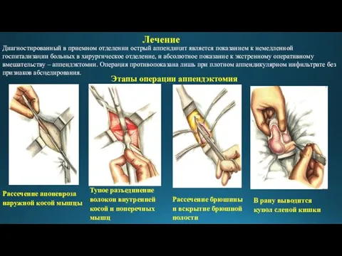 Этапы операции аппендэктомия Рассечение апоневроза наружной косой мышцы Тупое разъединение