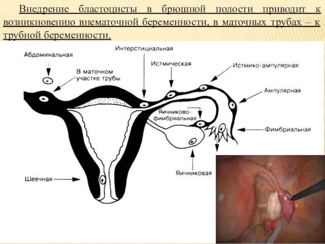 Внедрение бластоцисты в брюшной полости приводит к возникновению внематочной беременности, в маточных трубах
