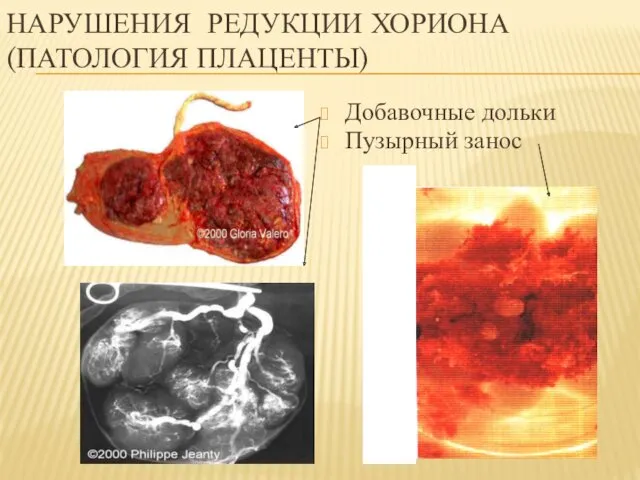 НАРУШЕНИЯ РЕДУКЦИИ ХОРИОНА (ПАТОЛОГИЯ ПЛАЦЕНТЫ) Добавочные дольки Пузырный занос