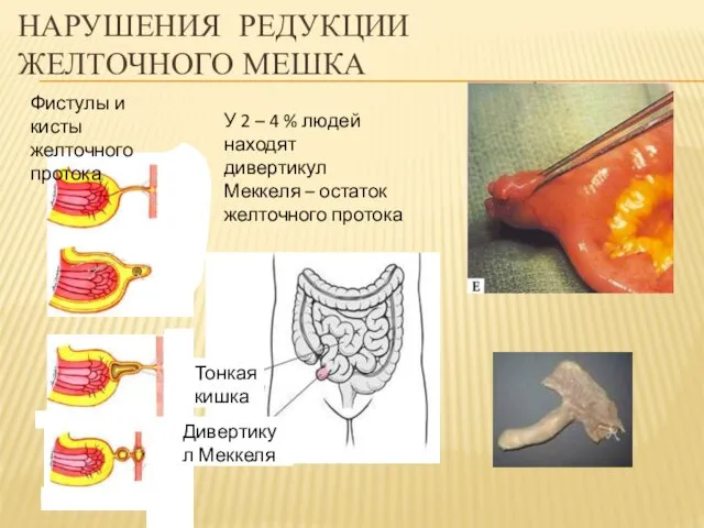 НАРУШЕНИЯ РЕДУКЦИИ ЖЕЛТОЧНОГО МЕШКА Фистулы и кисты желточного протока У 2 – 4