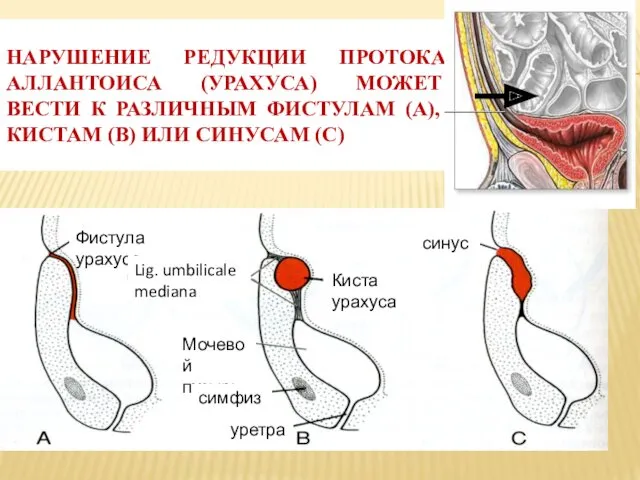 НАРУШЕНИЕ РЕДУКЦИИ ПРОТОКА АЛЛАНТОИСА (УРАХУСА) МОЖЕТ ВЕСТИ К РАЗЛИЧНЫМ ФИСТУЛАМ