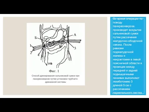 Во время операции по поводу панкреонекроза производят вскрытие сальниковой сумки