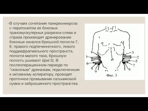 В случаях сочетания панкреонекроза с перитонитом из боковых трансмускулярных разрезов