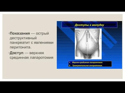 Показания — острый деструктивный панкреатит с явлениями перитонита. Доступ — верхняя срединная лапаротомия