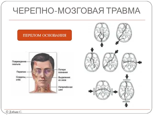 ЧЕРЕПНО-МОЗГОВАЯ ТРАВМА © Добыш С.А. ПЕРЕЛОМ ОСНОВАНИЯ