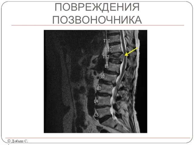 ПОВРЕЖДЕНИЯ ПОЗВОНОЧНИКА © Добыш С.А.