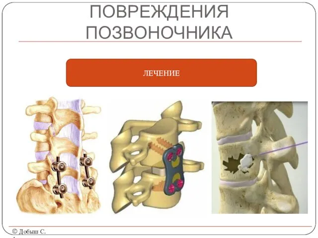 ПОВРЕЖДЕНИЯ ПОЗВОНОЧНИКА © Добыш С.А. ЛЕЧЕНИЕ