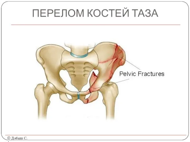 ПЕРЕЛОМ КОСТЕЙ ТАЗА © Добыш С.А.