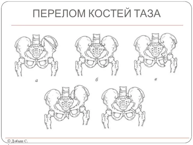 ПЕРЕЛОМ КОСТЕЙ ТАЗА © Добыш С.А.