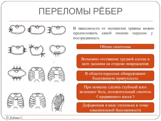 ПЕРЕЛОМЫ РЁБЕР © Добыш С.А. В зависимости от механизма травмы