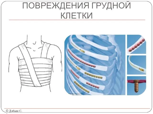 ПОВРЕЖДЕНИЯ ГРУДНОЙ КЛЕТКИ © Добыш С.А.