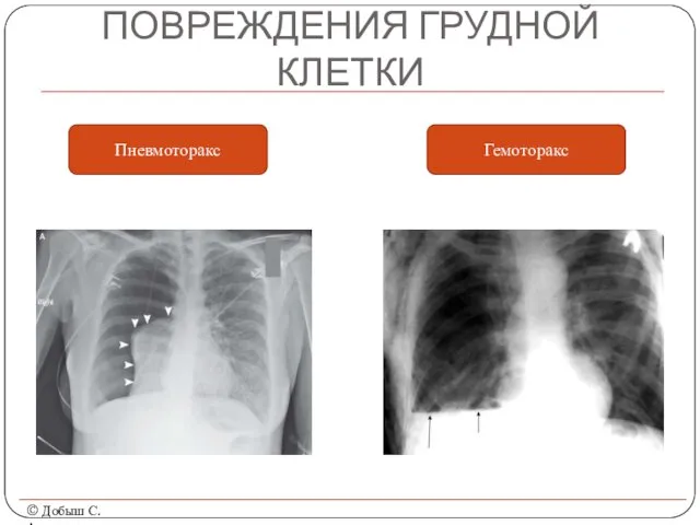 ПОВРЕЖДЕНИЯ ГРУДНОЙ КЛЕТКИ © Добыш С.А. Пневмоторакс Гемоторакс