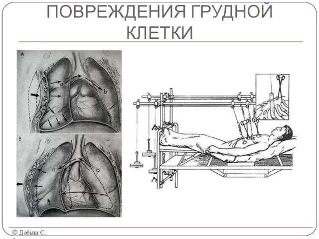 ПОВРЕЖДЕНИЯ ГРУДНОЙ КЛЕТКИ © Добыш С.А.