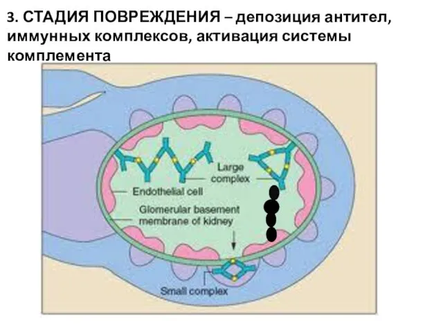 3. СТАДИЯ ПОВРЕЖДЕНИЯ – депозиция антител, иммунных комплексов, активация системы комплемента