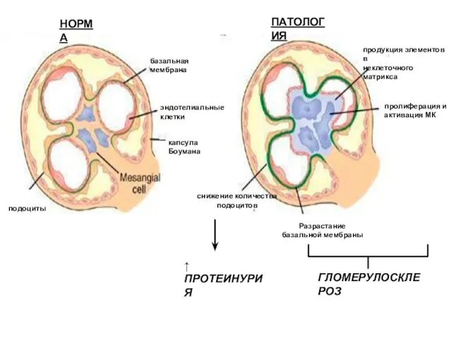 ↑ ПРОТЕИНУРИЯ ГЛОМЕРУЛОСКЛЕРОЗ НОРМА ПАТОЛОГИЯ