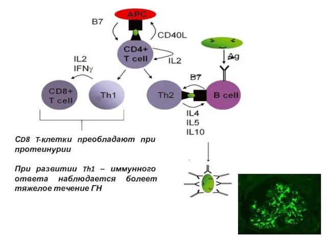 ?????? СD8 T-клетки преобладают при протеинурии При развитии Th1 –