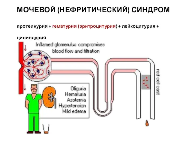 МОЧЕВОЙ (НЕФРИТИЧЕСКИЙ) СИНДРОМ протеинурия + гематурия (эритроцитурия) + лейкоцитурия + цилиндурия