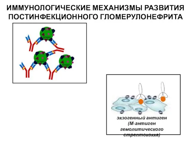 ИММУНОЛОГИЧЕСКИЕ МЕХАНИЗМЫ РАЗВИТИЯ ПОСТИНФЕКЦИОННОГО ГЛОМЕРУЛОНЕФРИТА экзогенный антиген (М-антиген гемолитического стрептококка)