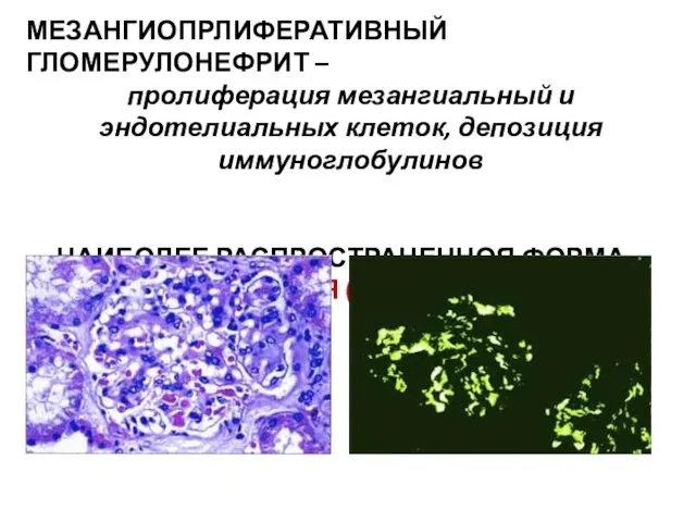 МЕЗАНГИОПРЛИФЕРАТИВНЫЙ ГЛОМЕРУЛОНЕФРИТ – пролиферация мезангиальный и эндотелиальных клеток, депозиция иммуноглобулинов