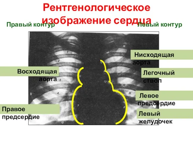 Правое предсердие Восходящая аорта Нисходящая аорта Легочный ствол Левое предсердие