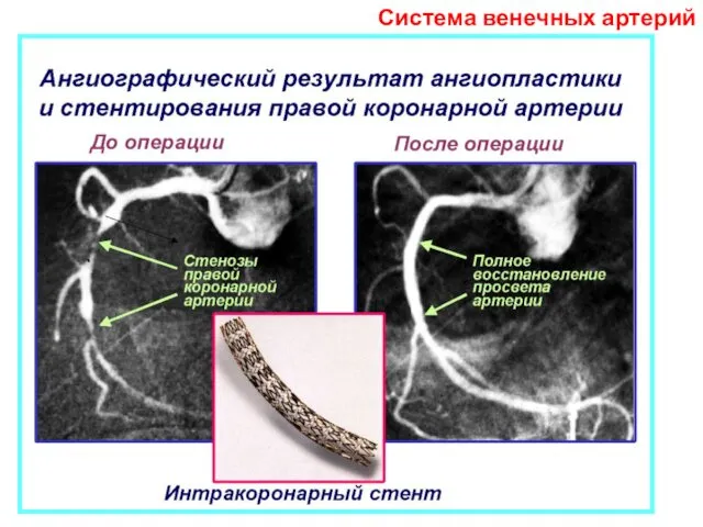 Система венечных артерий
