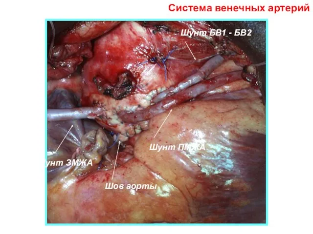 Шунт ЗМЖА Шунт ПМЖА Шунт БВ1 - БВ2 Шов аорты Система венечных артерий
